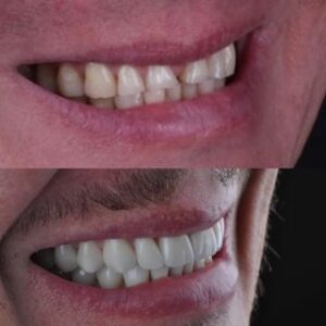 reabilitacao-oral-antes-depois-2