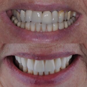reabilitacao-oral-antes-depois