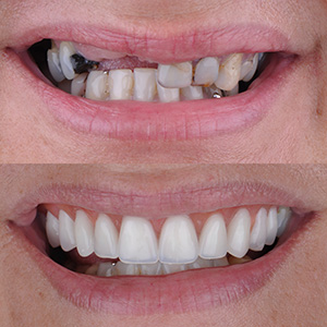 reabilitacao-oral-resultado-tratamento