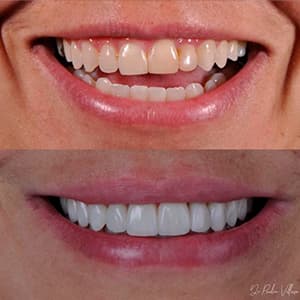 careamento-oral-antes-depois-2-300x300