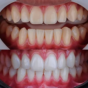 careamento-oral-antes-depois-300x300