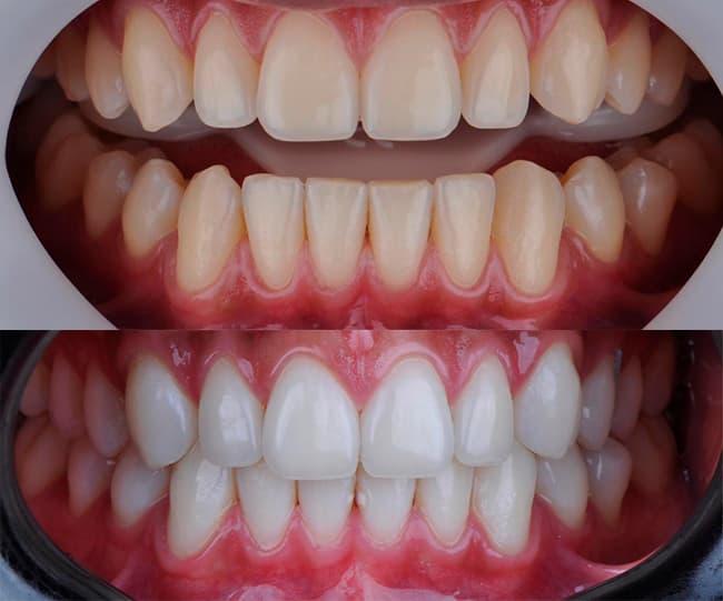 Como clarear os dentes com as técnicas de clareamento dental mais eficazes 1 Clareamento dental antes e depois