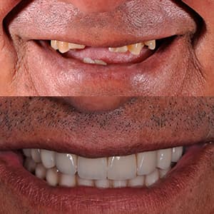 reabilitacao-oral-antes-depois-10-300x300