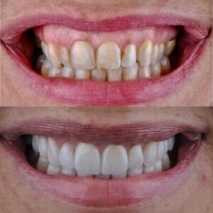Antes e depois lentes de contato dental
