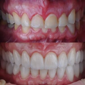 Antes e depois lentes de contato dental