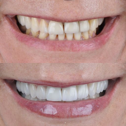 LP - Lentes 9 1-Lente nos Dentes em Goiânia - Villaça Odontologia (1)